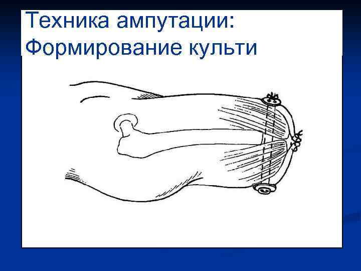 Техника ампутации: Формирование культи 