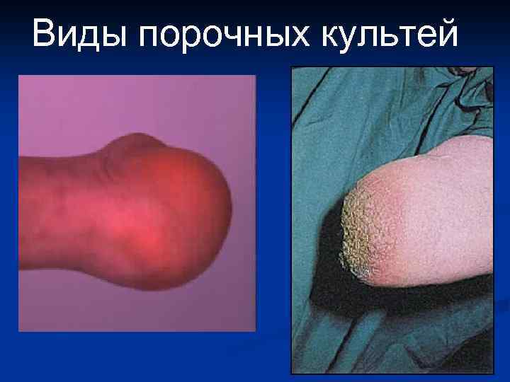 Виды порочных культей 