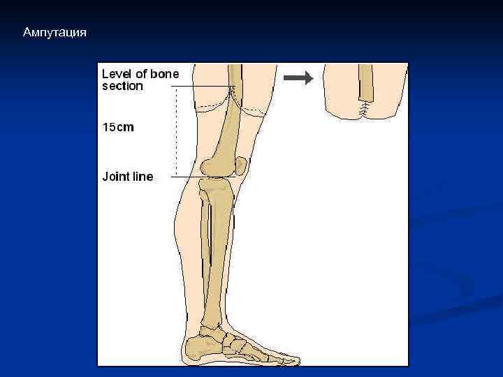 Ампутация 