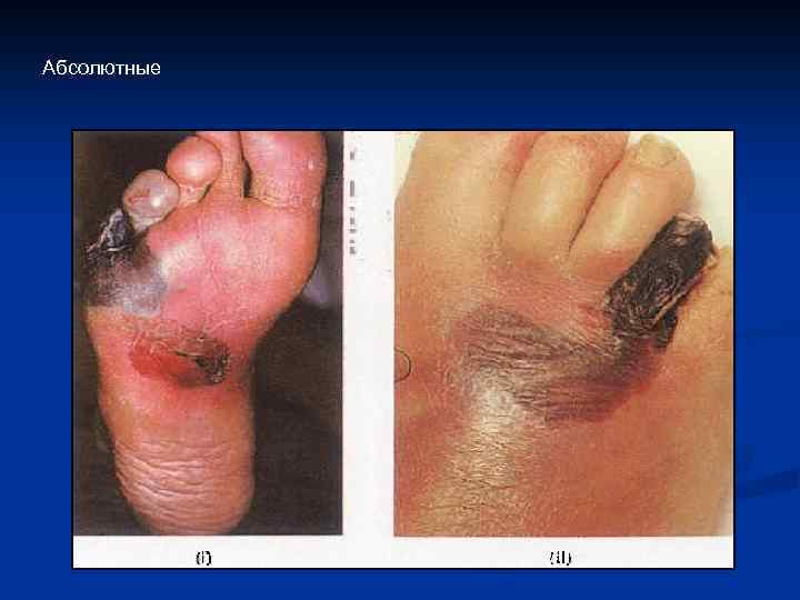 Абсолютные 