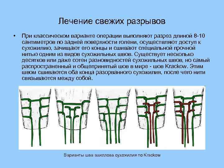 Операции на сухожилиях презентация