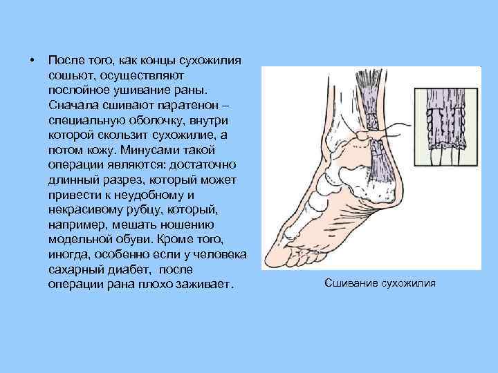  • После того, как концы сухожилия сошьют, осуществляют послойное ушивание раны. Сначала сшивают