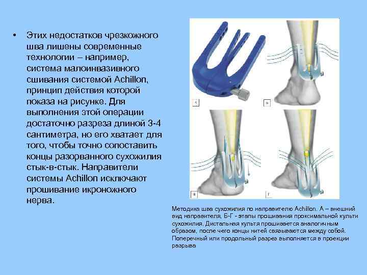 Операции на сухожилиях презентация