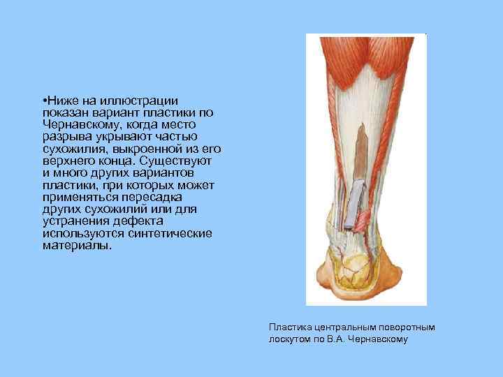  • Ниже на иллюстрации показан вариант пластики по Чернавскому, когда место разрыва укрывают