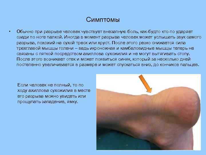Симптомы • Обычно при разрыве человек чувствует внезапную боль, как-будто кто-то ударяет сзади по