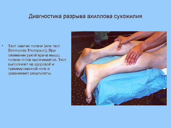 Диагностика разрыва ахиллова сухожилия • Тест сжатия голени (или тест Simmonds-Thompson). При сжимании рукой