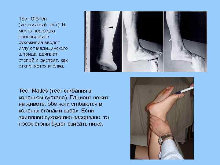 Тест O’Brien (игольчатый тест). В место перехода апоневроза в сухожилие вводят иглу от медицинского