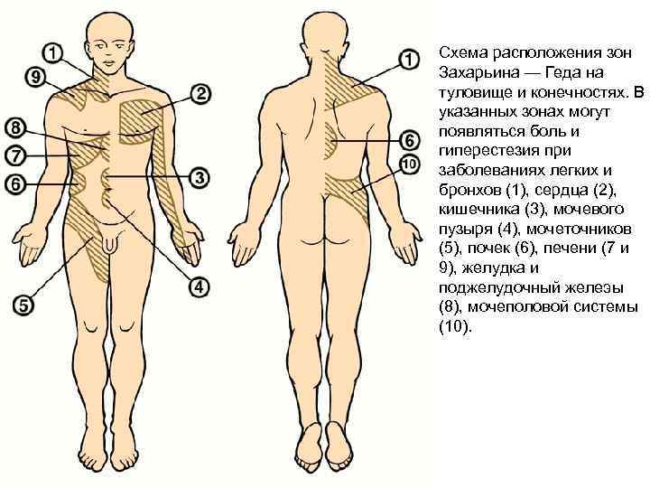 Схема расположения зон Захарьина — Геда на туловище и конечностях. В указанных зонах могут