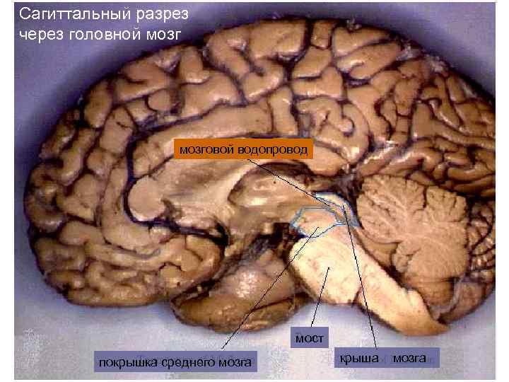 Сагиттальный разрез через головной мозговой водопровод мост покрышка среднего мозга крыша мозга 