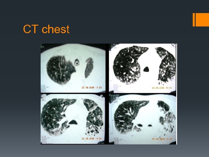 CT chest 