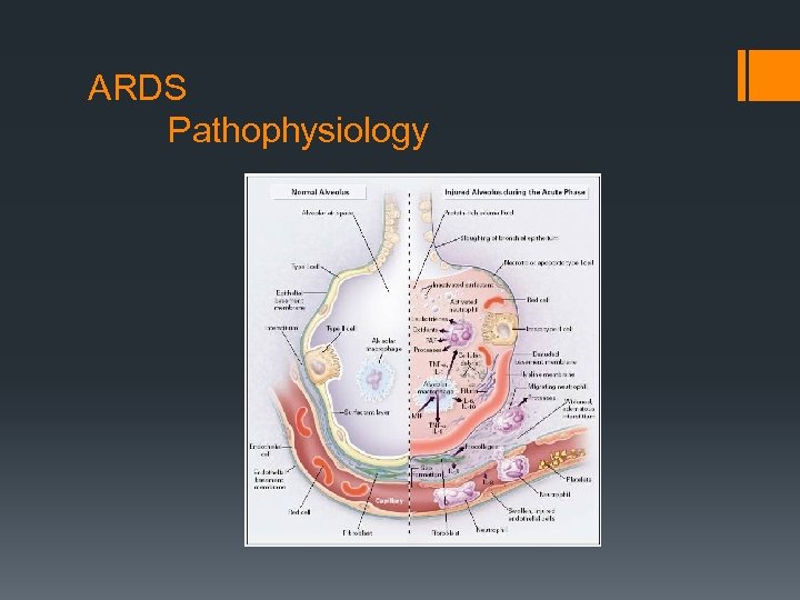 ARDS Pathophysiology 