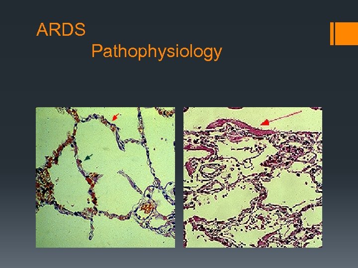 ARDS Pathophysiology 