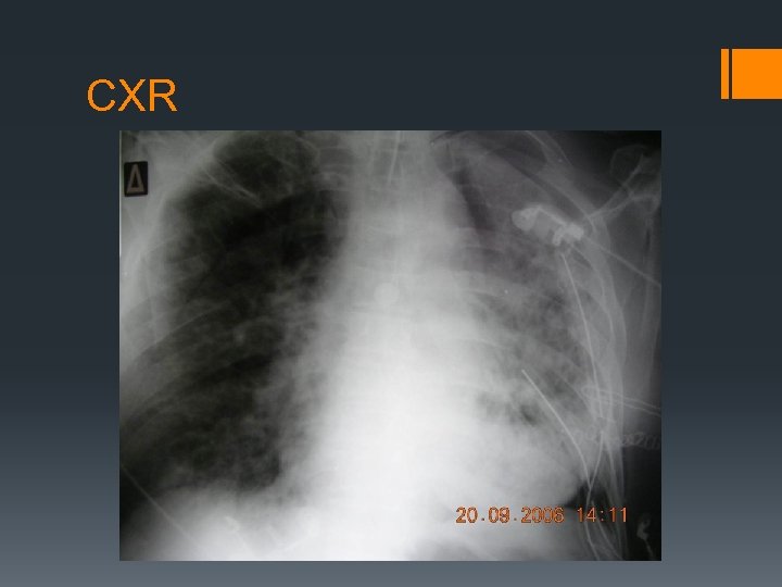 CXR 
