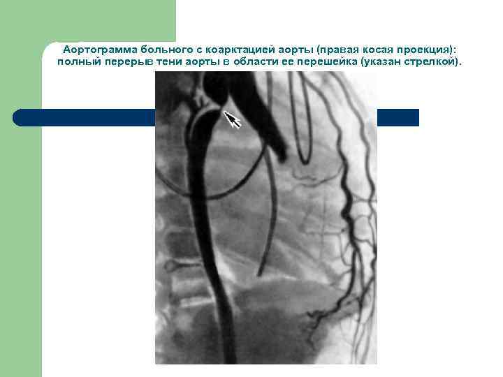 Аортограмма больного с коарктацией аорты (правая косая проекция): полный перерыв тени аорты в области