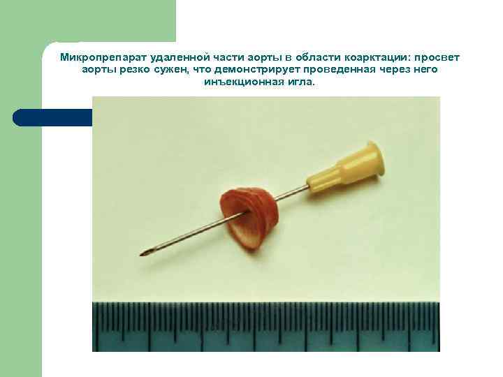 Микропрепарат удаленной части аорты в области коарктации: просвет аорты резко сужен, что демонстрирует проведенная