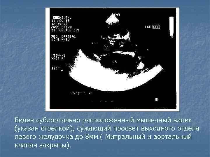 Виден субаортально расположенный мышечный валик (указан стрелкой), сужающий просвет выходного отдела левого желудочка до