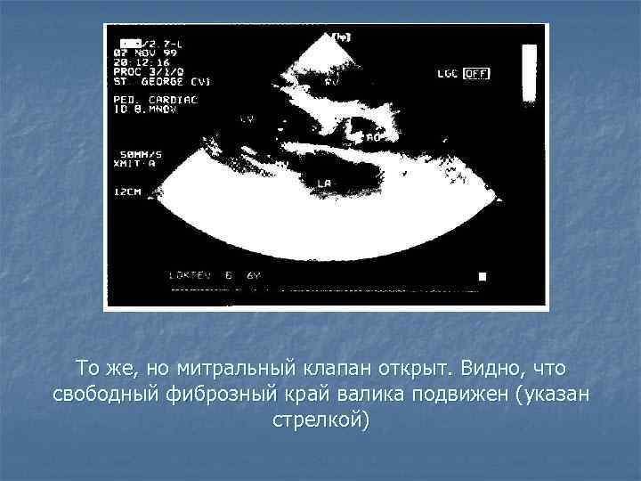 То же, но митральный клапан открыт. Видно, что свободный фиброзный край валика подвижен (указан