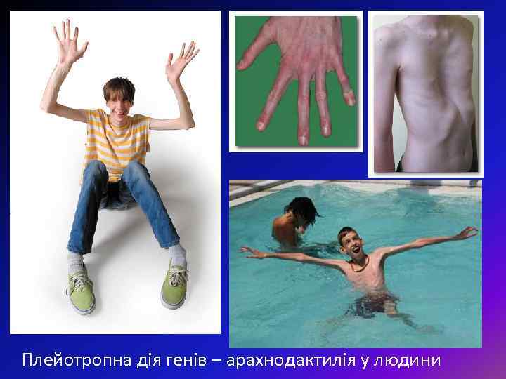 Плейотропна дія генів – арахнодактилія у людини 
