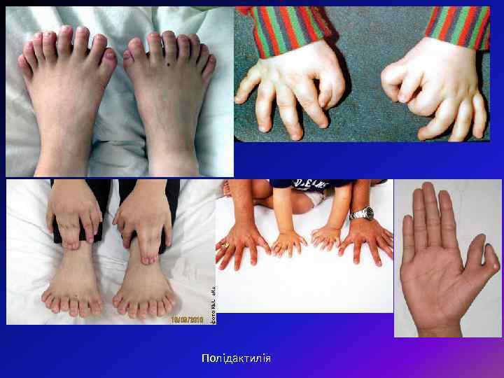 Полідактилія 
