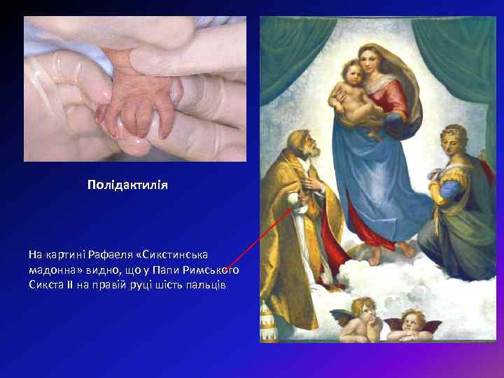 Полідактилія На картині Рафаеля «Сикстинська мадонна» видно, що у Папи Римського Сикста II на