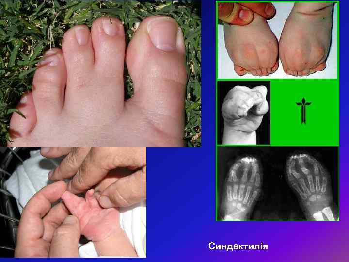 Синдактилія 