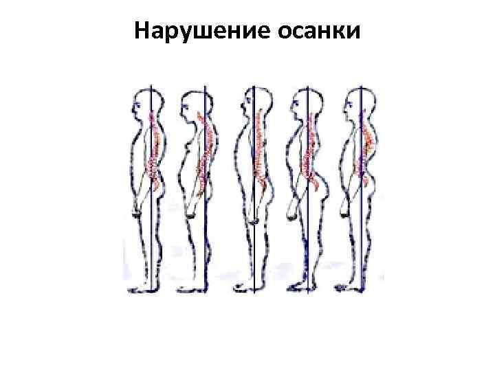 Нарушение осанки 