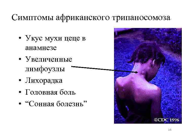 Симптомы африканского трипаносомоза • Укус мухи цеце в анамнезе • Увеличенные лимфоузлы • Лихорадка