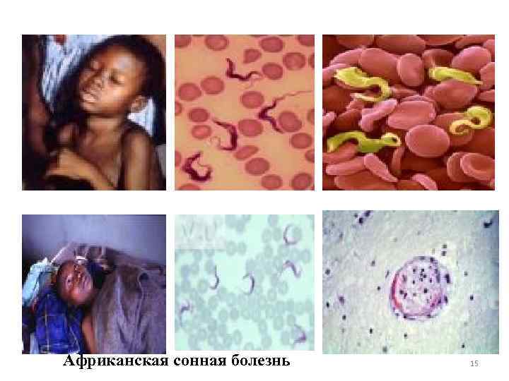 Африканская сонная болезнь 15 