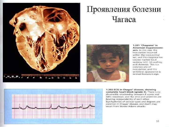 Проявления болезни Symptoms of African and American trypanosomiasis. Чагаса 18 