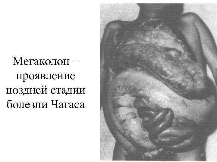 Мегаколон – проявление поздней стадии болезни Чагаса 19 