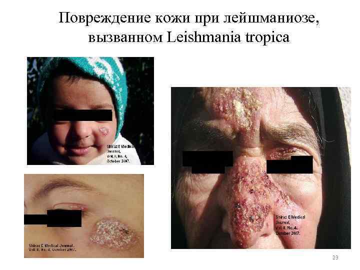Повреждение кожи при лейшманиозе, вызванном Leishmania tropica 23 