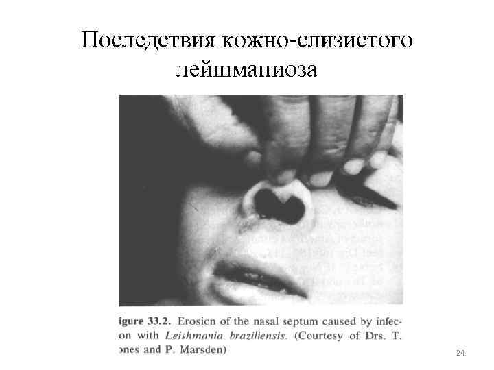 Последствия кожно-слизистого лейшманиоза 24 