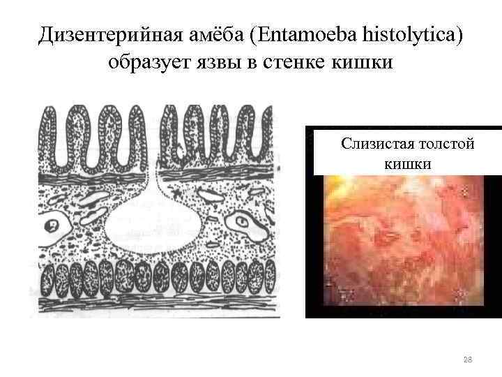 Дизентерийная амёба (Entamoeba histolytica) образует язвы в стенке кишки Слизистая толстой кишки 28 