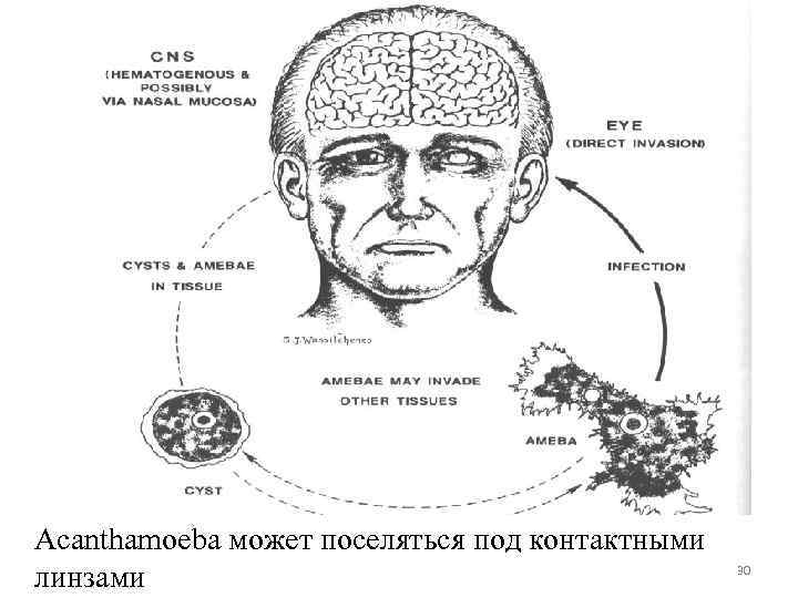 Acanthamoeba может поселяться под контактными линзами 30 