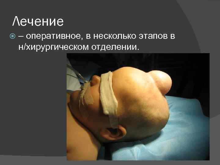 Лечение – оперативное, в несколько этапов в н/хирургическом отделении. 