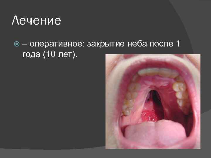 Лечение – оперативное: закрытие неба после 1 года (10 лет). 
