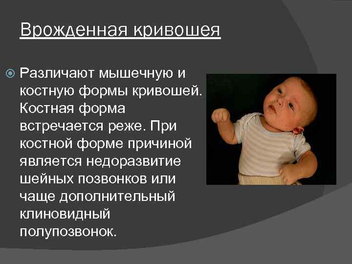 Врожденная кривошея Различают мышечную и костную формы кривошей. Костная форма встречается реже. При костной