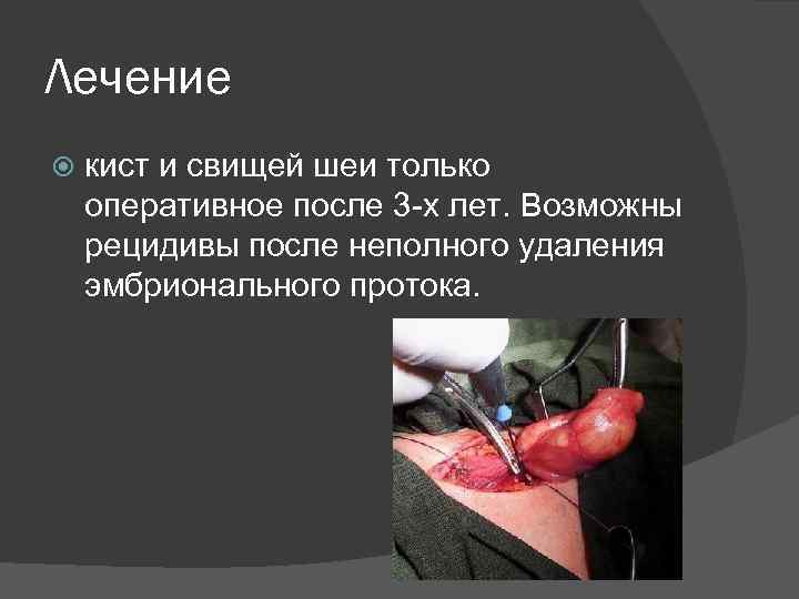 Лечение кист и свищей шеи только оперативное после 3 -х лет. Возможны рецидивы после