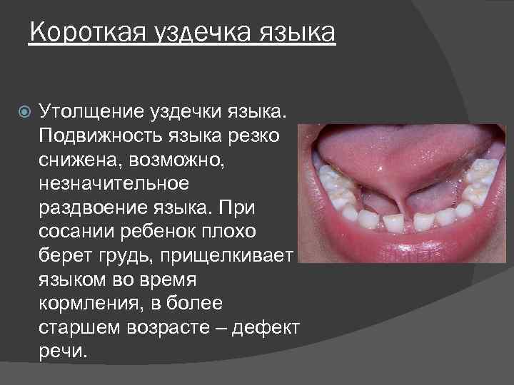 Короткая уздечка языка Утолщение уздечки языка. Подвижность языка резко снижена, возможно, незначительное раздвоение языка.