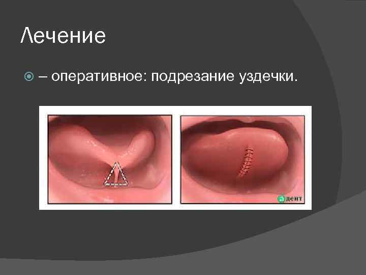 Лечение – оперативное: подрезание уздечки. 