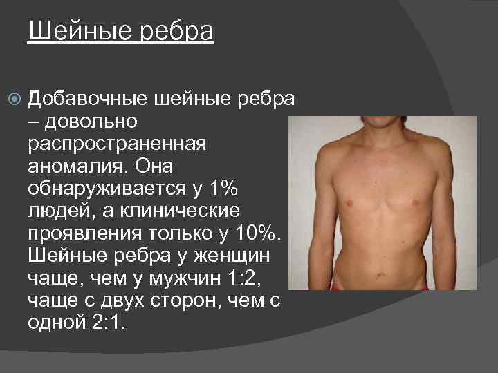 Шейные ребра Добавочные шейные ребра – довольно распространенная аномалия. Она обнаруживается у 1% людей,