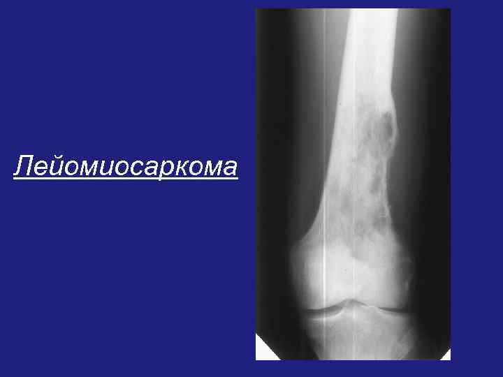 Лейомиосаркома 