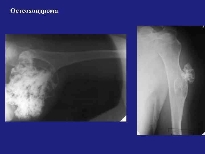 Остеохондрома бедренной. Остеохондрома лопатки рентген. Остеохондрома бедренной кости рентген. Остеохондрома кости рентген. Остеохондрома плечевой кости рентген.