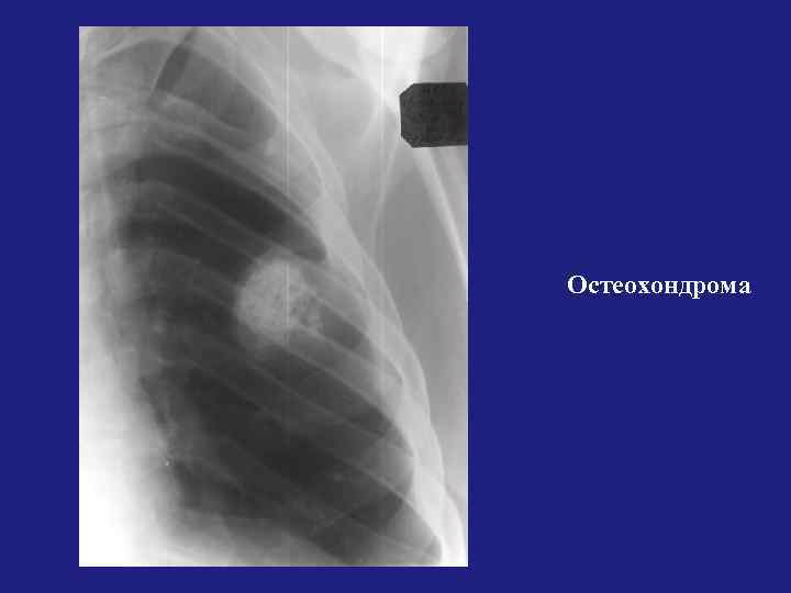 Остеохондрома 