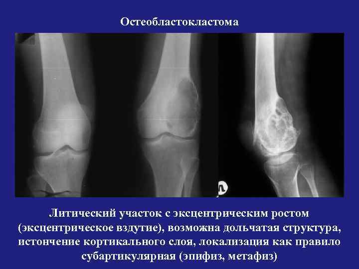 Опухоли лучевой кости. Гигантоклеточная опухоль большеберцовой кости. Опухоли большеберцовой кости на рентгене. Гигантоклеточная опухоль бедренной кости мрт. Гигантоклеточная опухоль кости кт.