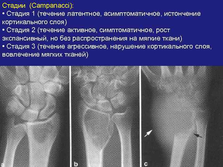 Стадии (Сampanacci): • Стадия 1 (течение латентное, асимптоматичное, истончение кортикального слоя) • Стадия 2
