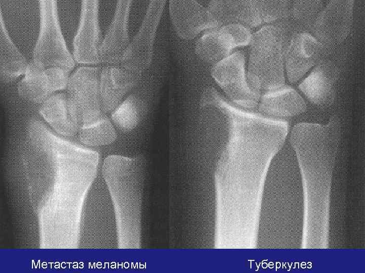 Метастаз меланомы Туберкулез 
