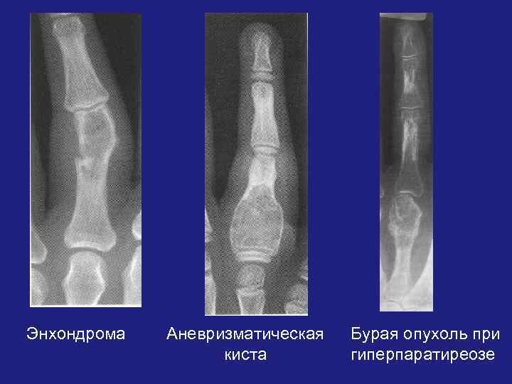 Энхондрома Аневризматическая киста Бурая опухоль при гиперпаратиреозе 