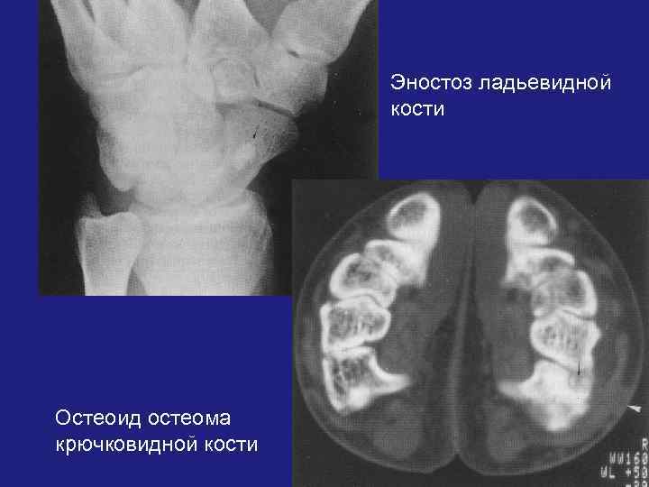 Эностоз ладьевидной кости Остеоид остеома крючковидной кости 