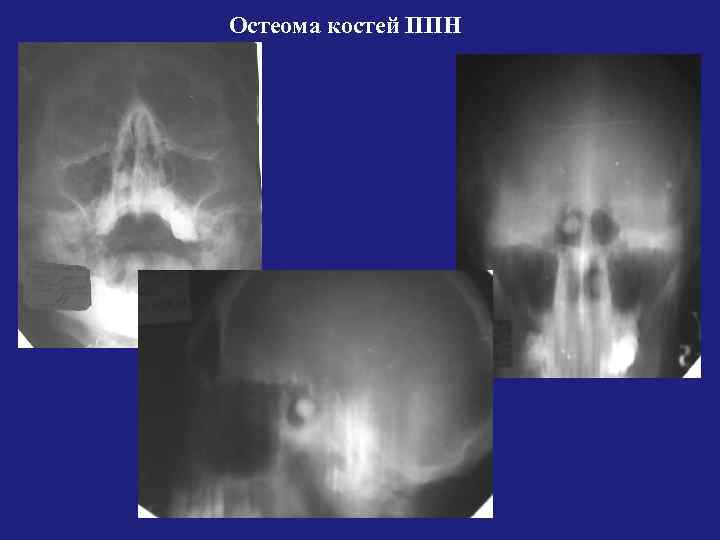 Остеома костей ППН 